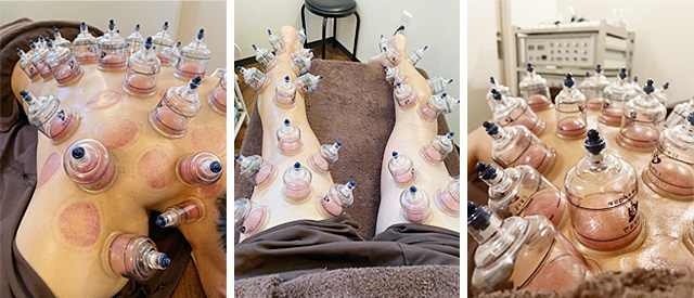 カッピング療法のイメージ